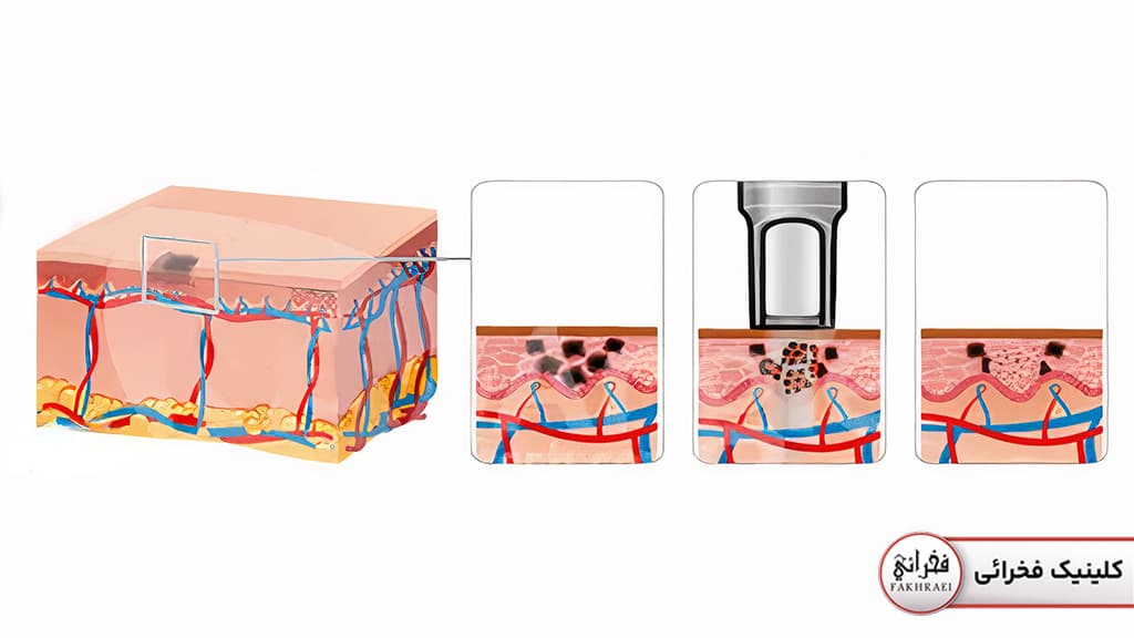 نحوه کار لیزر کیوسوئیچ برای ریممو تاتو