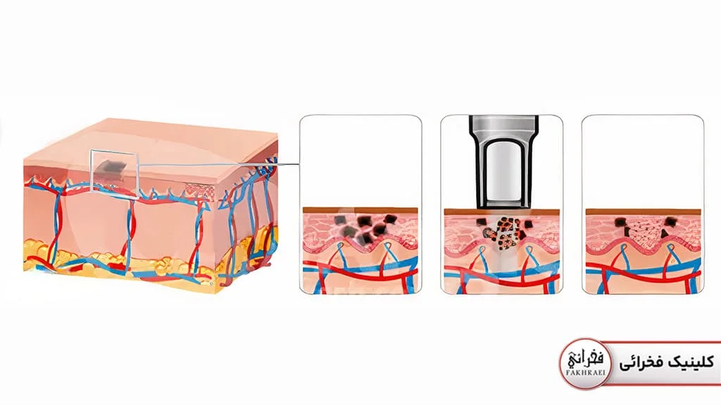 نحوه کار لیزر کیوسوئیچ برای ریممو تاتو