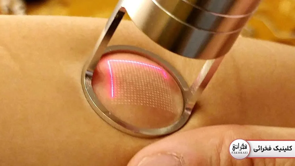 دستگاه لیزر CO2