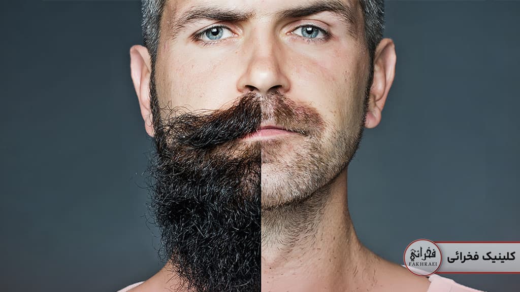 تفاوت داشتن یا نداشتن ریش