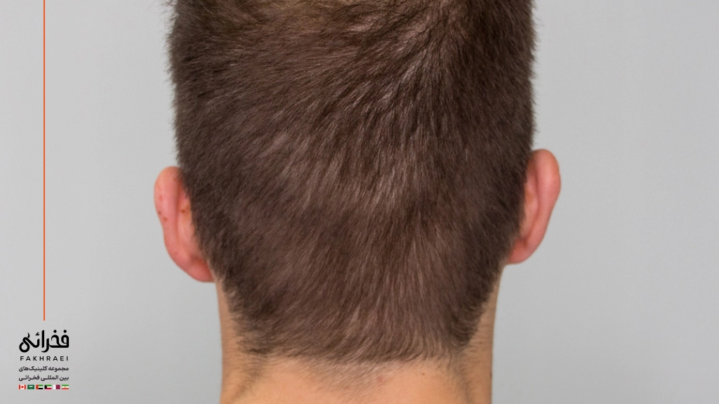 وضعیت بانک مو بعد از کاشت