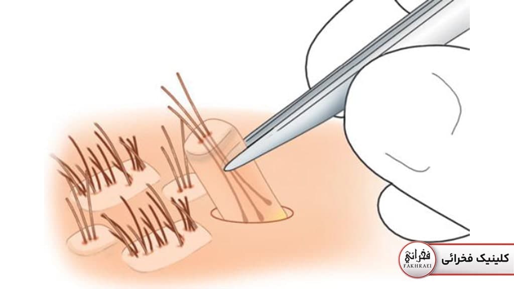 استخراج فولیکول مو برای کاشت ریش
