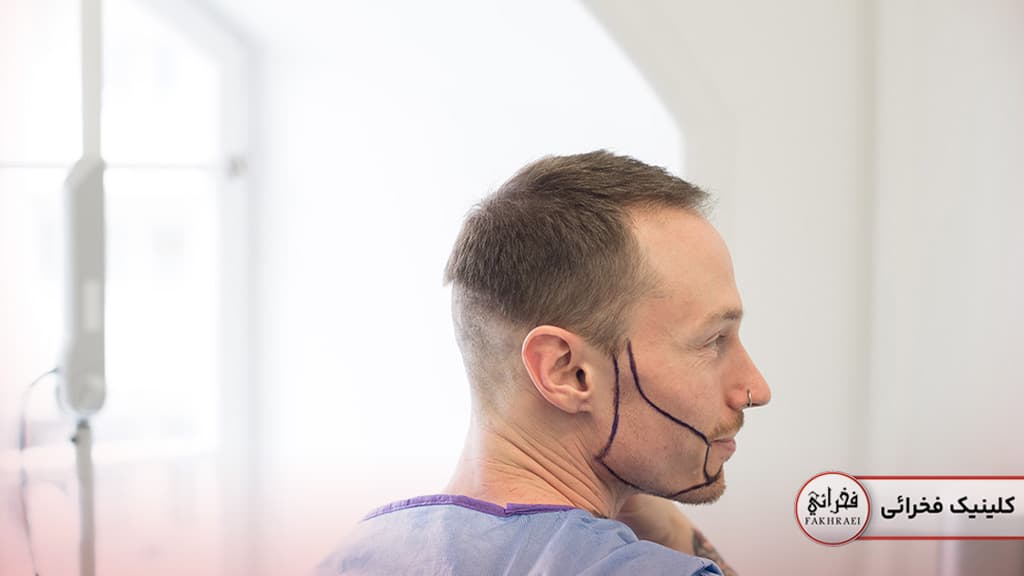 طراحی خط ریش در روش FIT