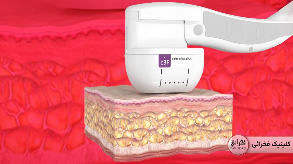 نمایش گرافیکی نوع فعالیت هایفو برای غبغب