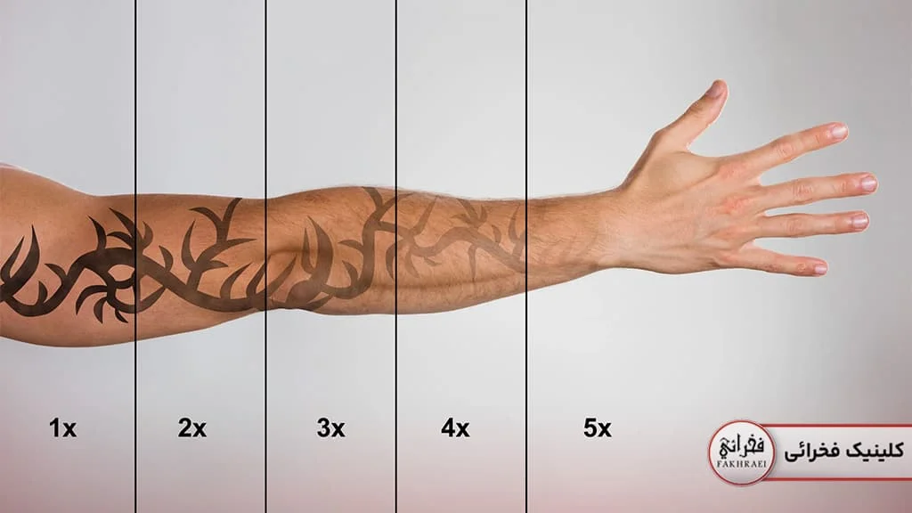 ریموو تاتو با لیزر کیوسوئیچ