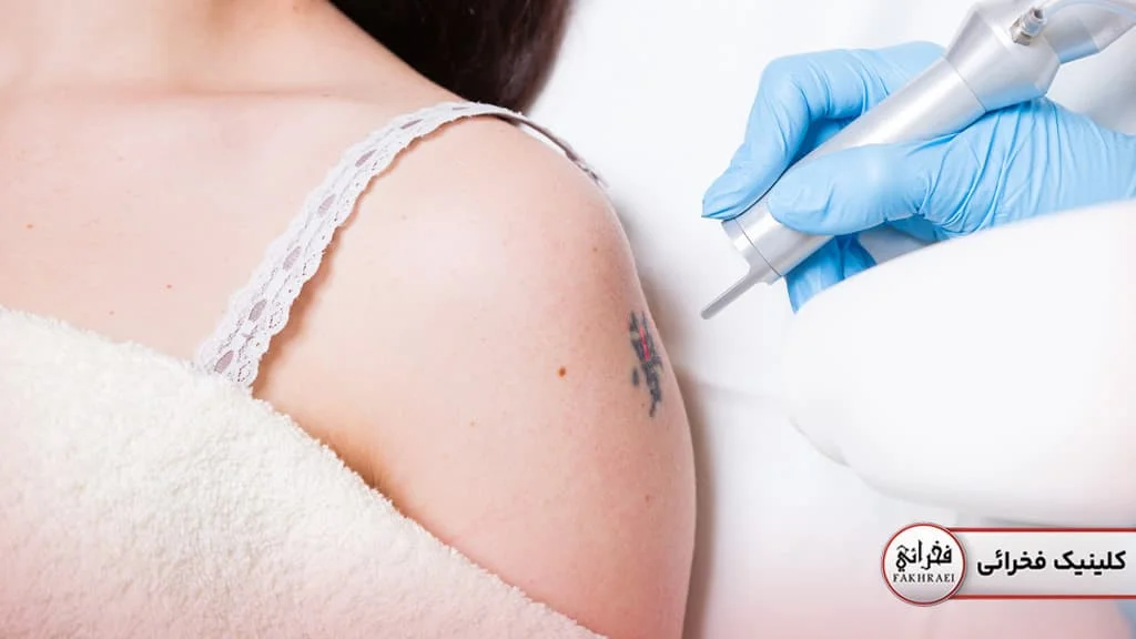 انواع لیزرهای زیبایی : دستگاه لیزر کیوسوئیچ