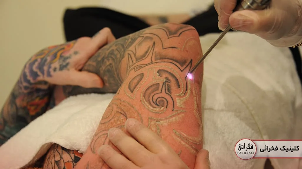 عوارض ریموو تتو با لیزر کیوسوئیچ