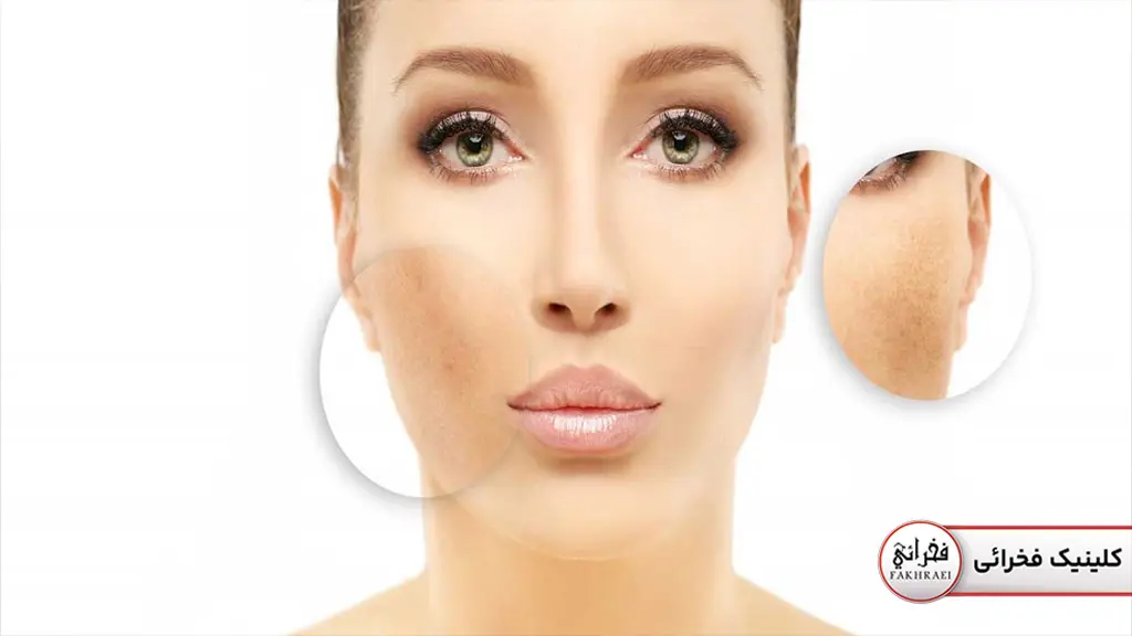 درمان ماه گرفتگی با لیزر کیوسوئیچ