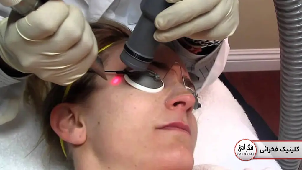 خانمی در حال انجام لیزر فوتونا برای افتادگی پلک