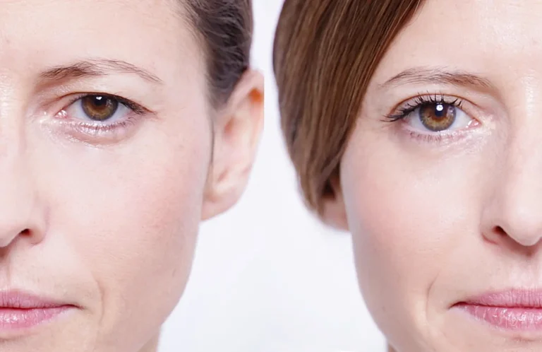 درمان افتادگی پلک چگونه عمل می‌کند؟ + معرفی جدید روش دنیا