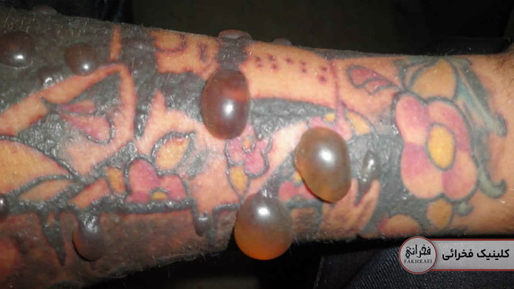 درماتیت آلرژیک در اثر تتو