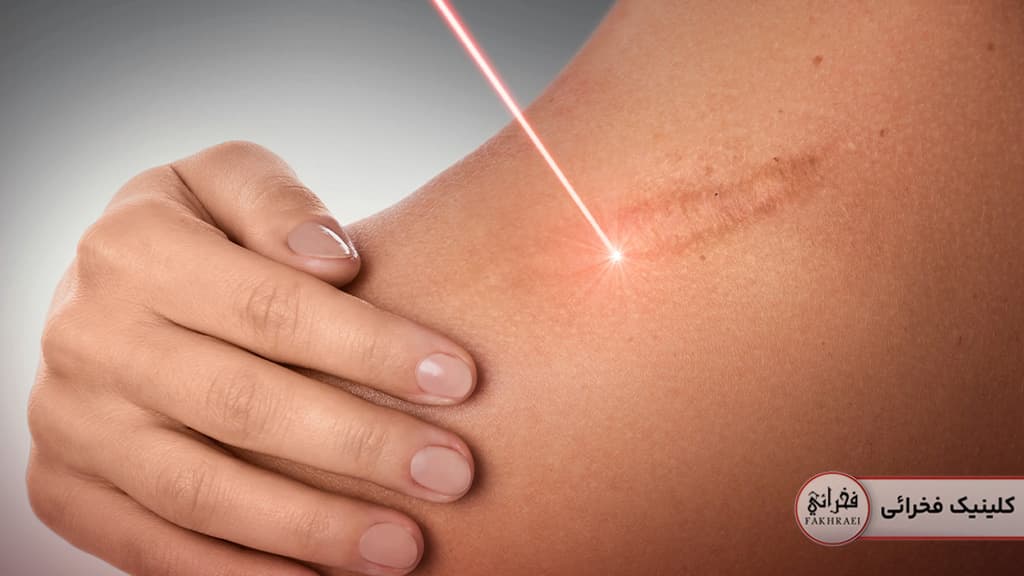 بررسی تفاوت لیزر فوتونا و فرکشنال