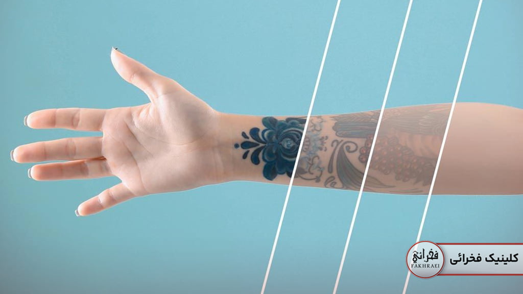 پاک کردن تاتو چگونه است؟