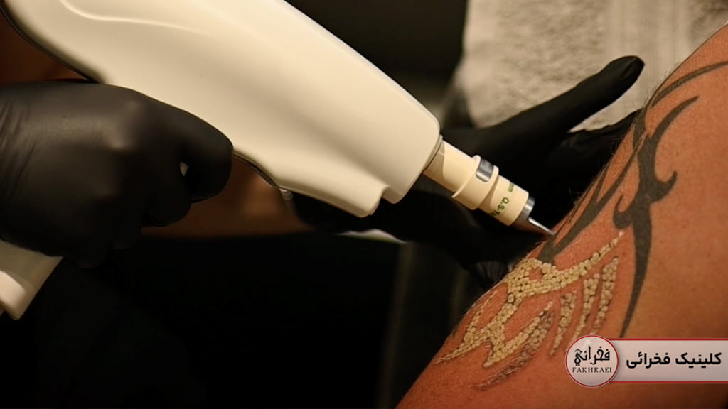 پاک کردن تتو