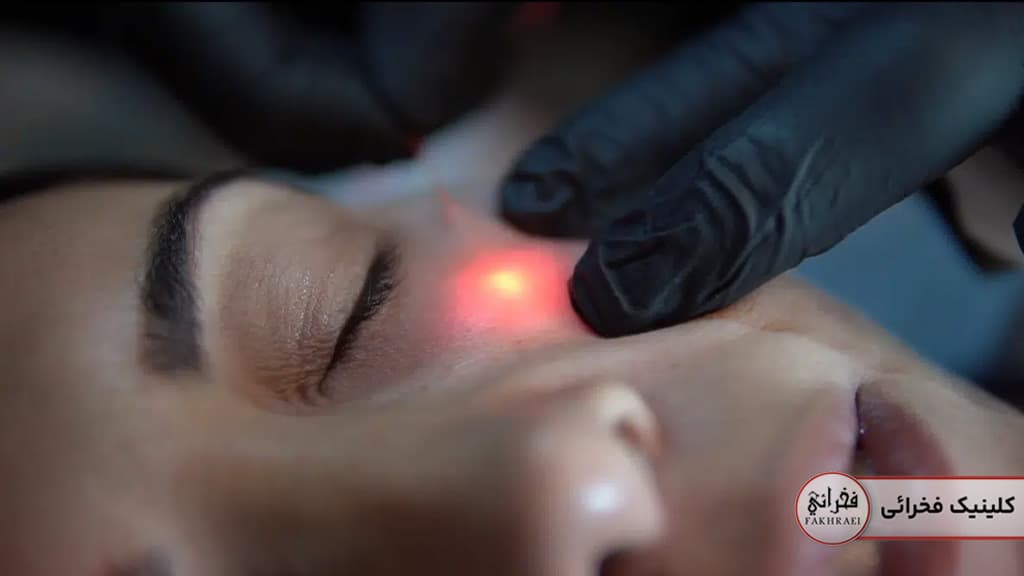 جوانسازی با اندولیفت