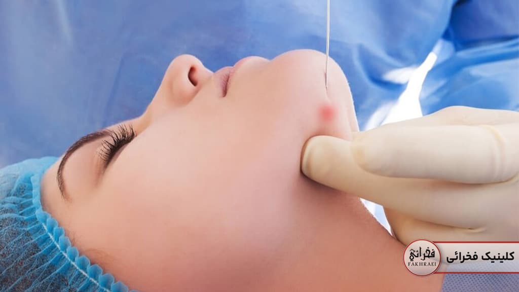 کاربرد‌های اندولیفت