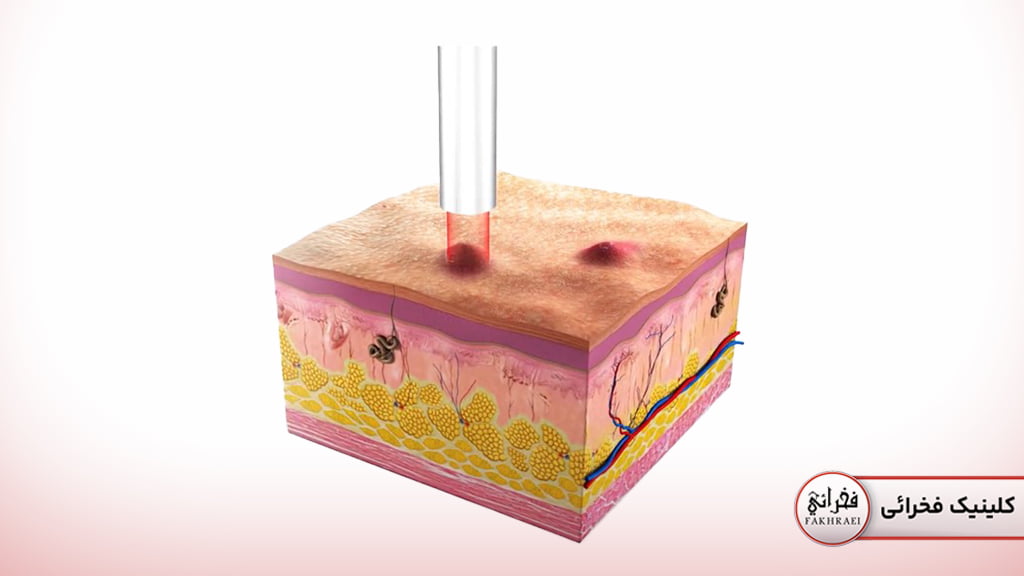 اجزای پوست و تاثیر لیزر فوتونا بر جای جوش