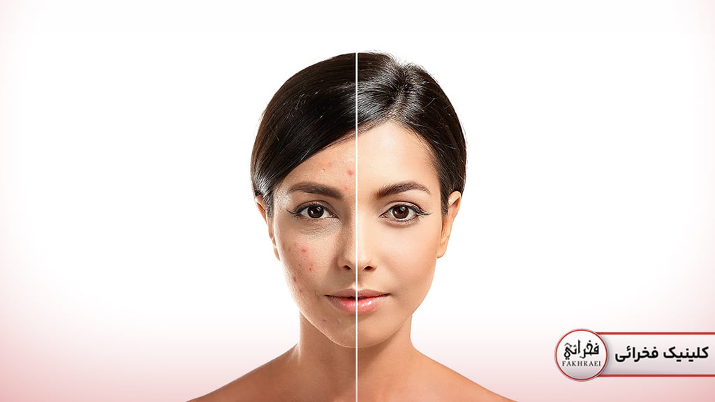 فوتونا برای جای جوش