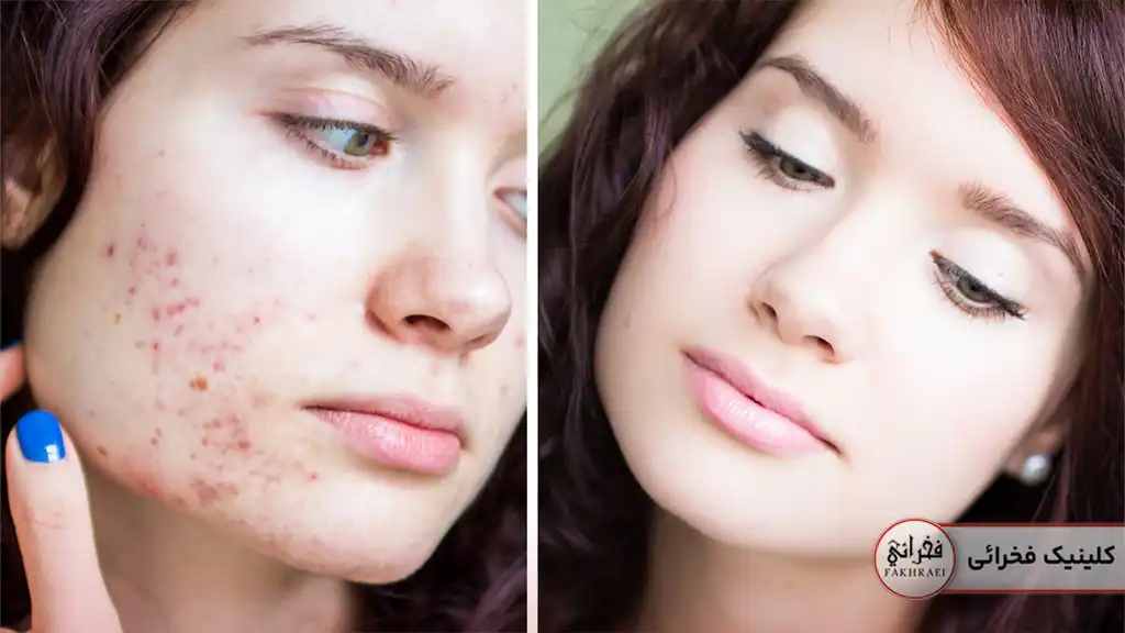 جای جوش که با کیوسوئیچ درمان شده