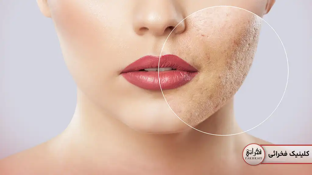 جای جوش در صورت که با کیوسوئیچ حل می‌شود