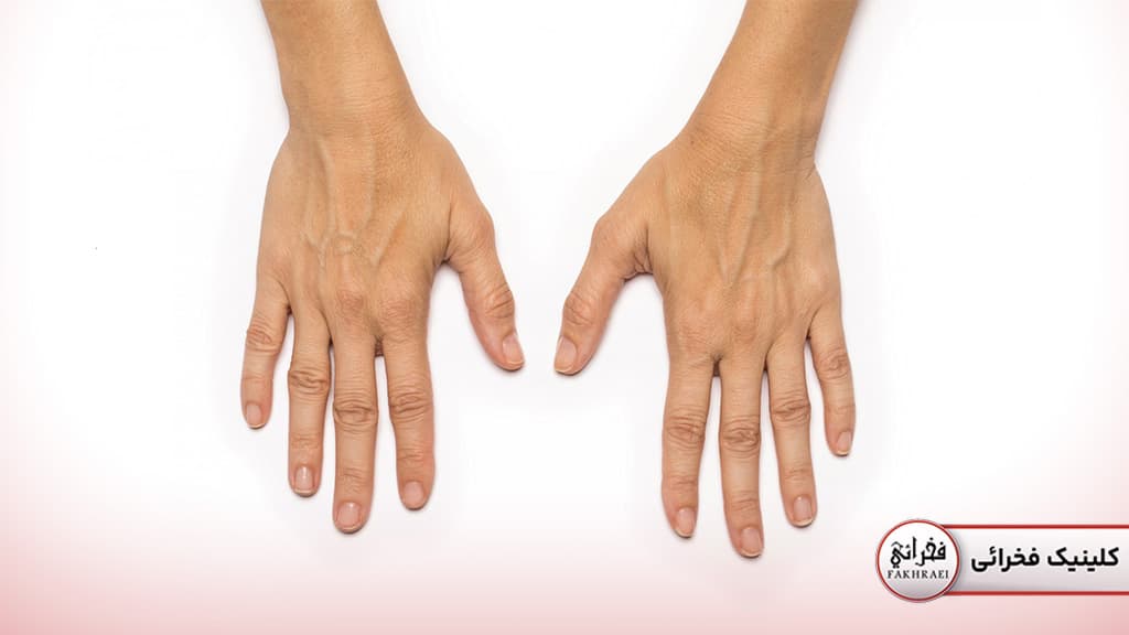 جلوگیری از پیری پوست دست