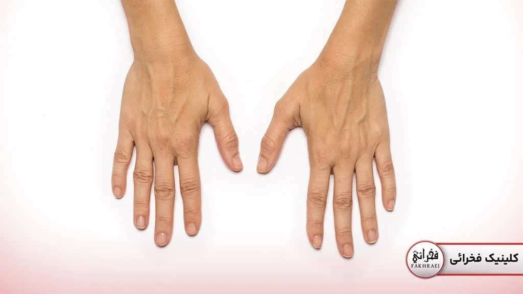 جلوگیری از پیری پوست دست