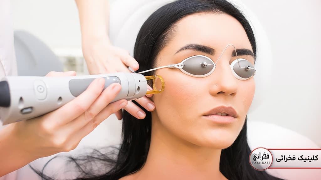 لیزر موی کرکی صورت