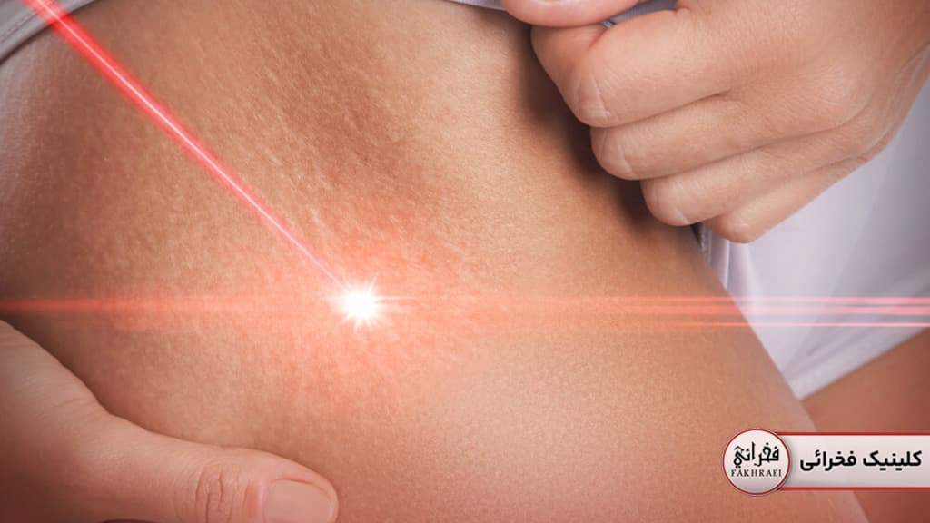 درمان استرچ مارک با لیزر