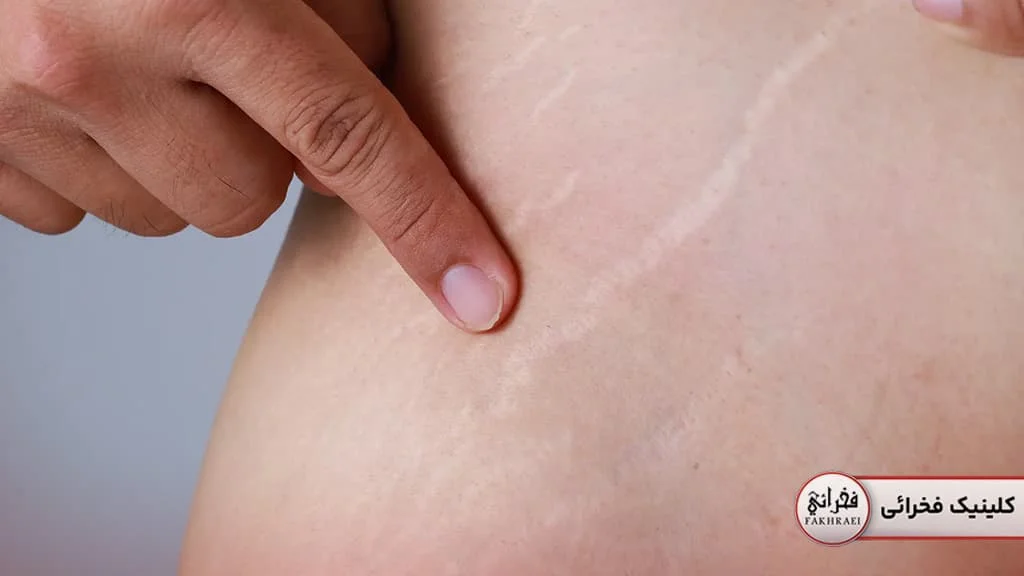 استرچ مارک چیست