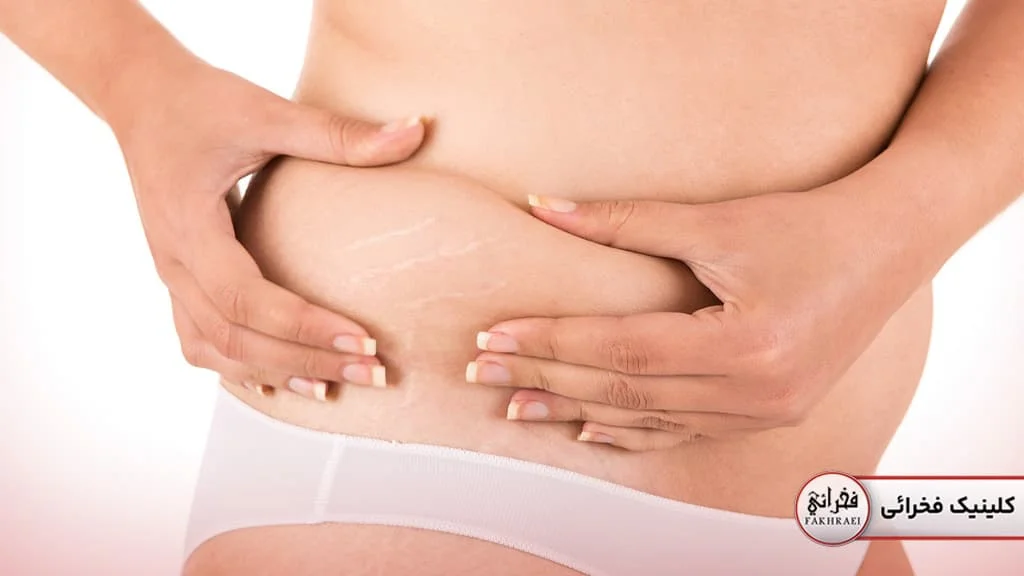 مراحل درمان استرچ مارک