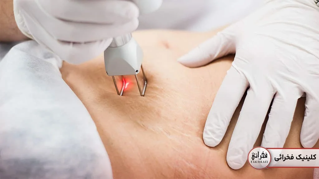 درمان استرچ مارک با لیزر co2