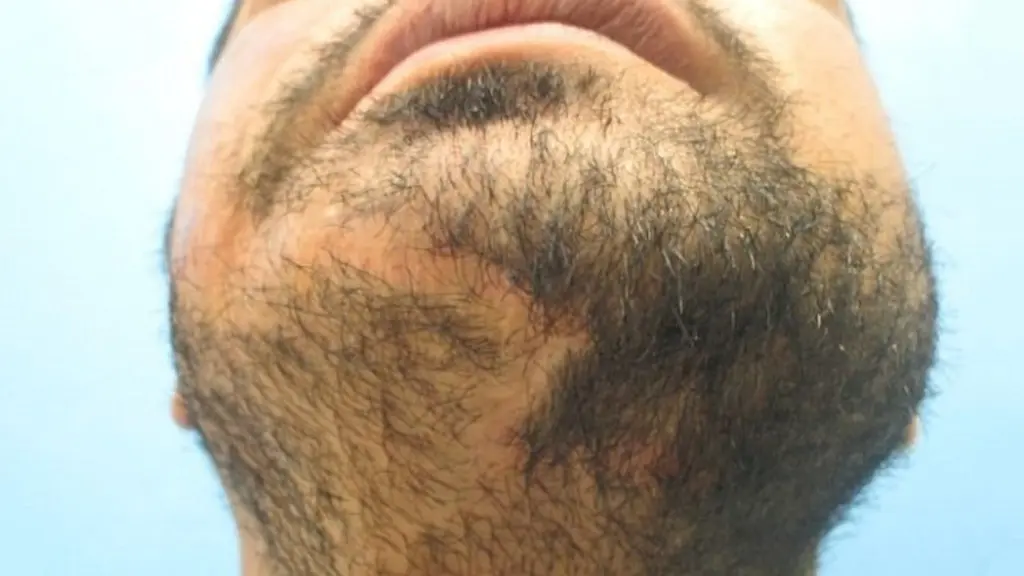 روش‌های کاشت ریش روی جای زخم