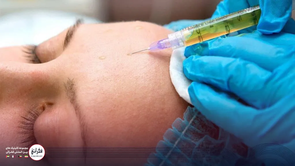 تزریق پی ار پی در پیشانی