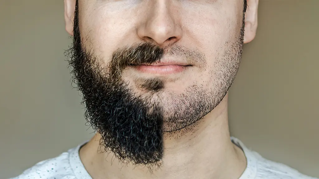 نحوه کاشت ریش روی جای زخم