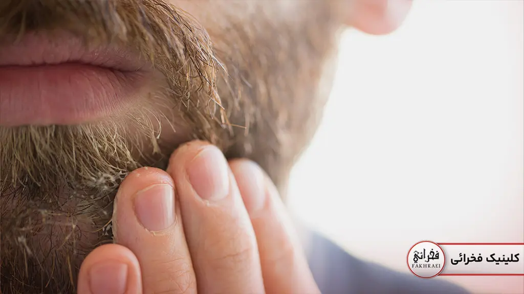 کاهش عوارض کاشت ریش