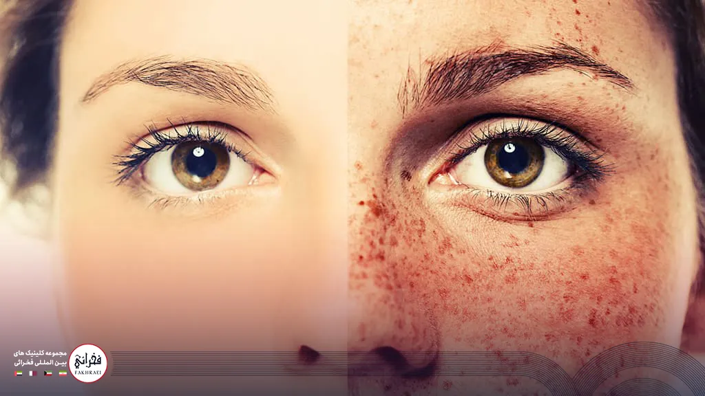 عکس قبل و بعد از انجام لیزر کیوسوییچ 