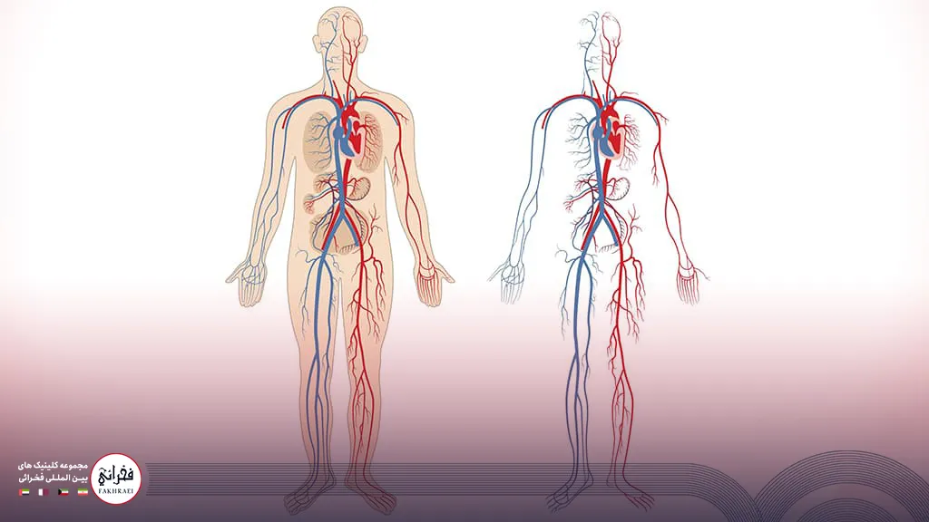 واریس چگونه ایجاد می‌شود؟