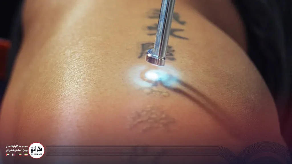 عکس در حال انجام لیزر کیوسوییچ 