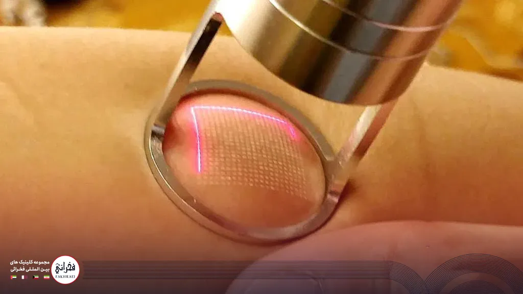 لیزر CO2 فرکشنال چیست؟