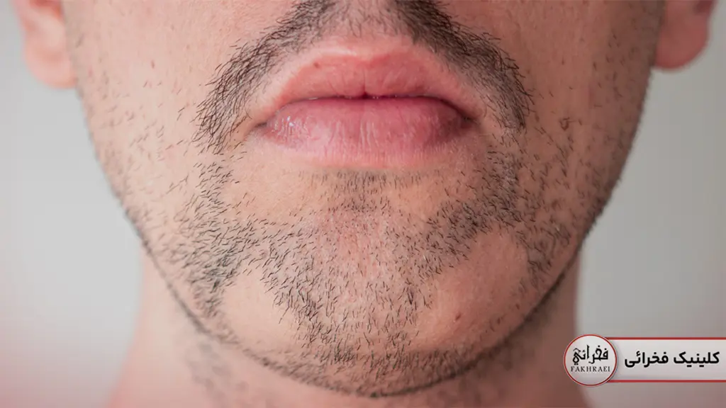 ایا کاشت ریش عوارض دارد