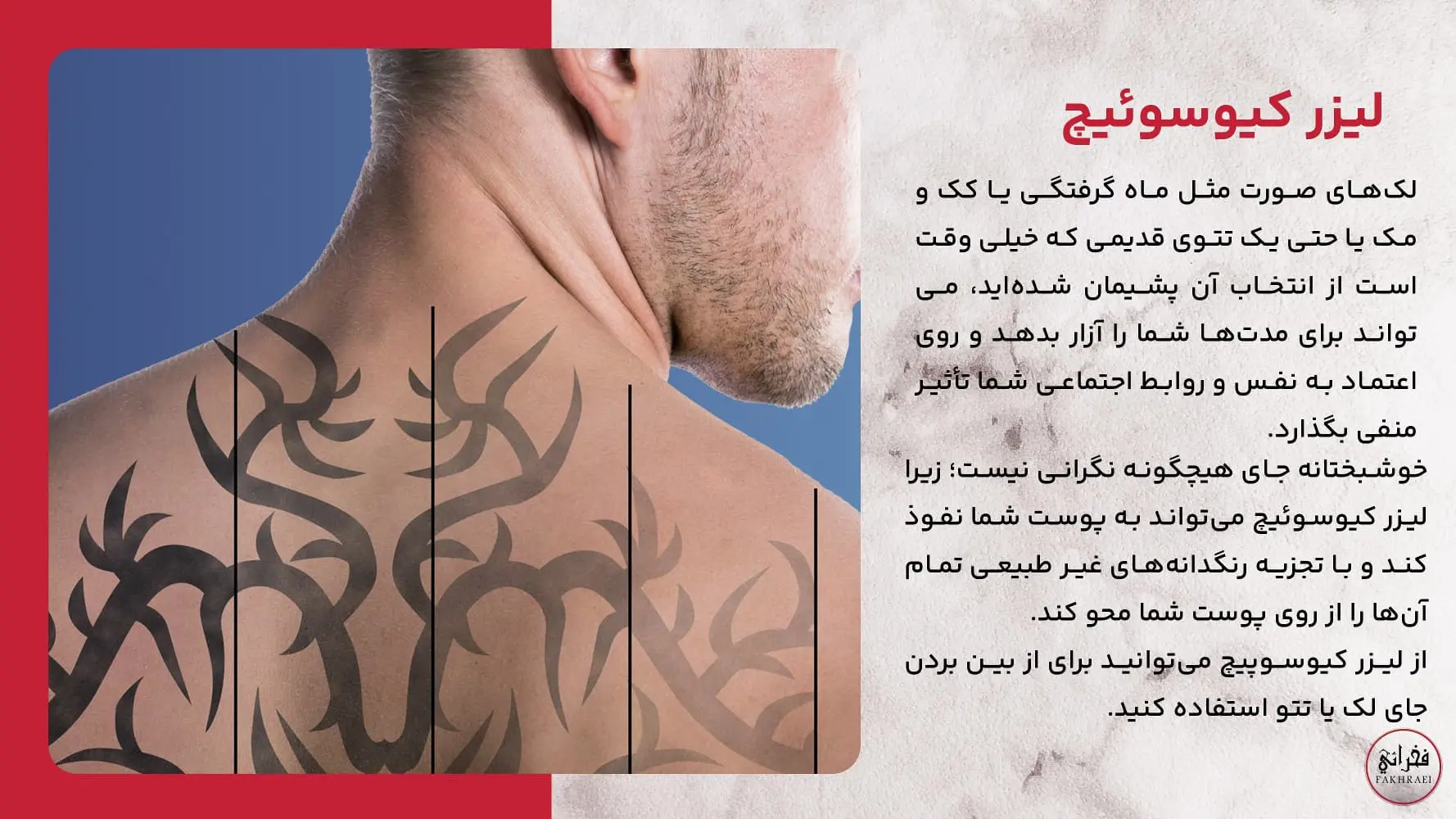 توضیحات در مورد لیزر کیوسوئیچ چیست