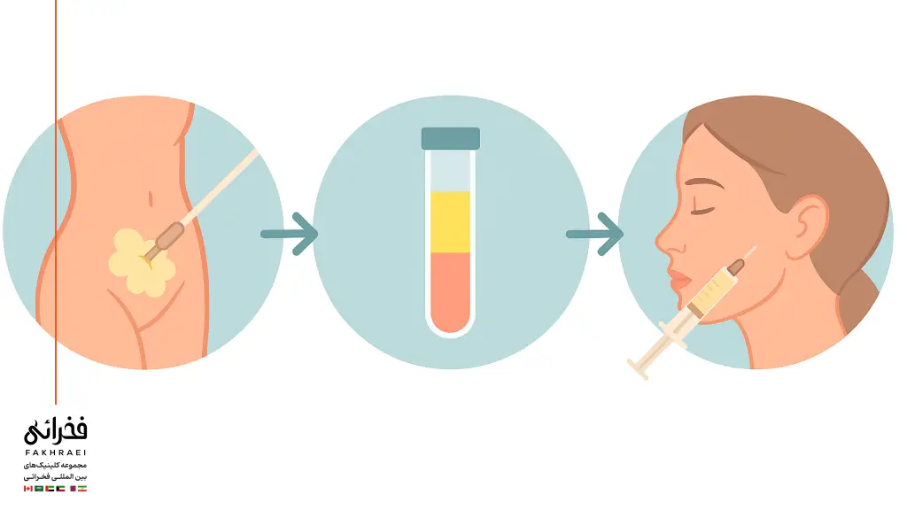 مراحل تزریق چربی