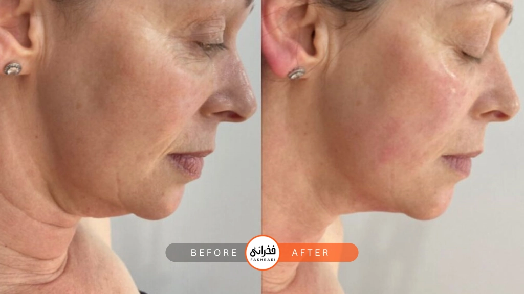 عکس قبل و بعد از هایفوتراپی