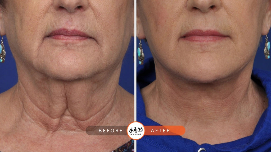 مزایای هایفوتراپی