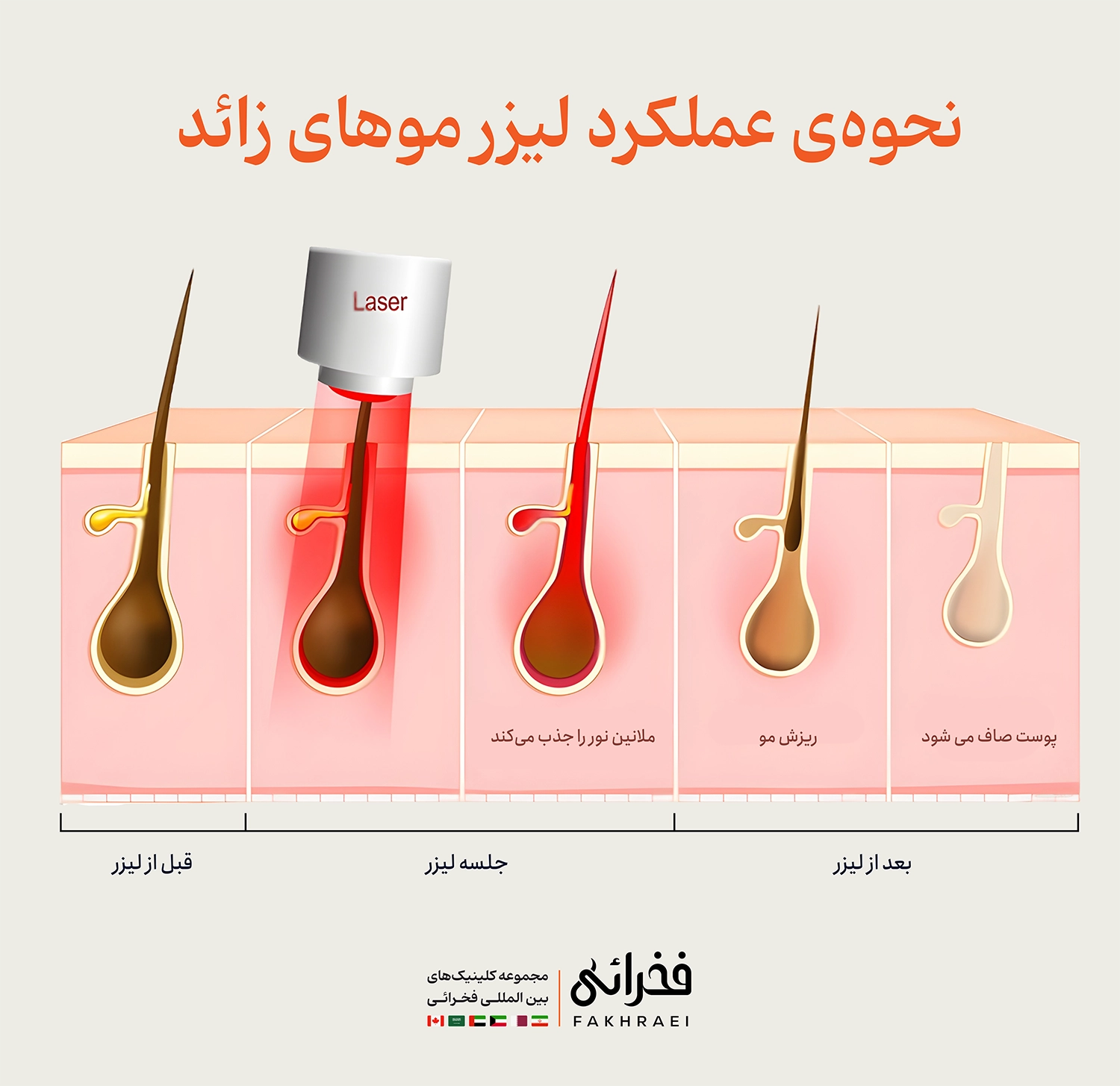 نحوه‌ عملکرد لیزر موهای زائد