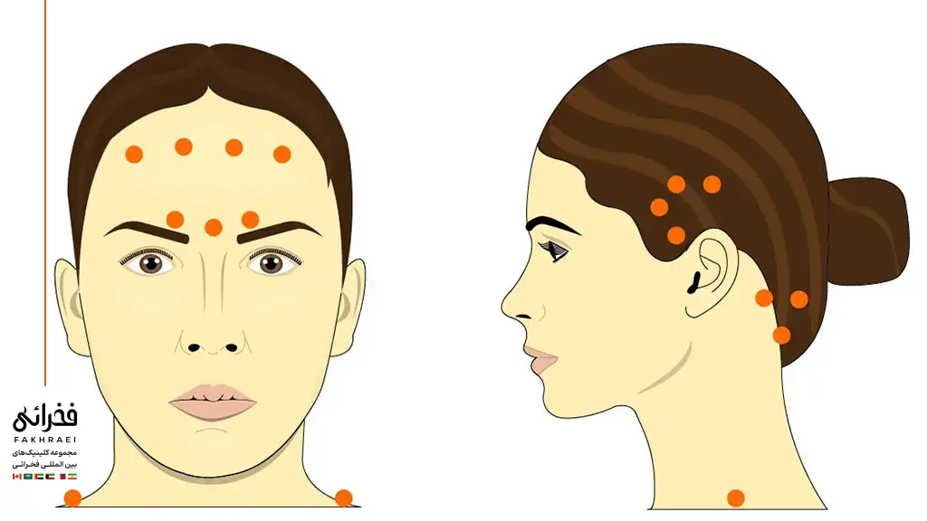 نقاط تزریق بوتاکس برای درمان میگرن