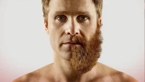 کاشت ریش برای افراد کوسه