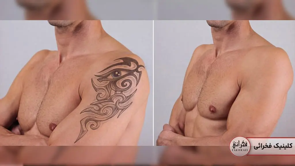 پاک کردن تتو با لیزر کیوسوئیچ