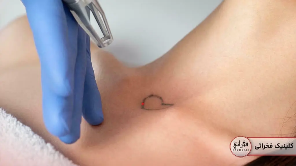 مراقب‌های بعد از لیزر کیوسوئیچ