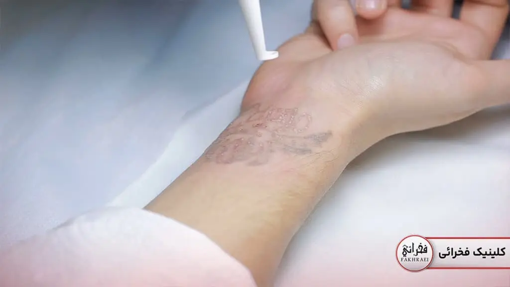 آشنایی با نقاهت کیوسوئیچ